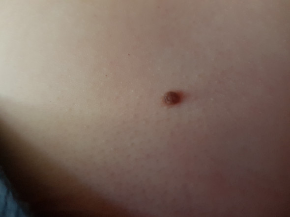 Muttermal Mit Rand Hautkrebs