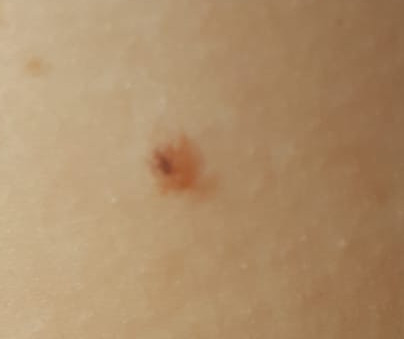 Muttermal normal oder gefährlich? (Gesundheit und Medizin, Hautarzt)