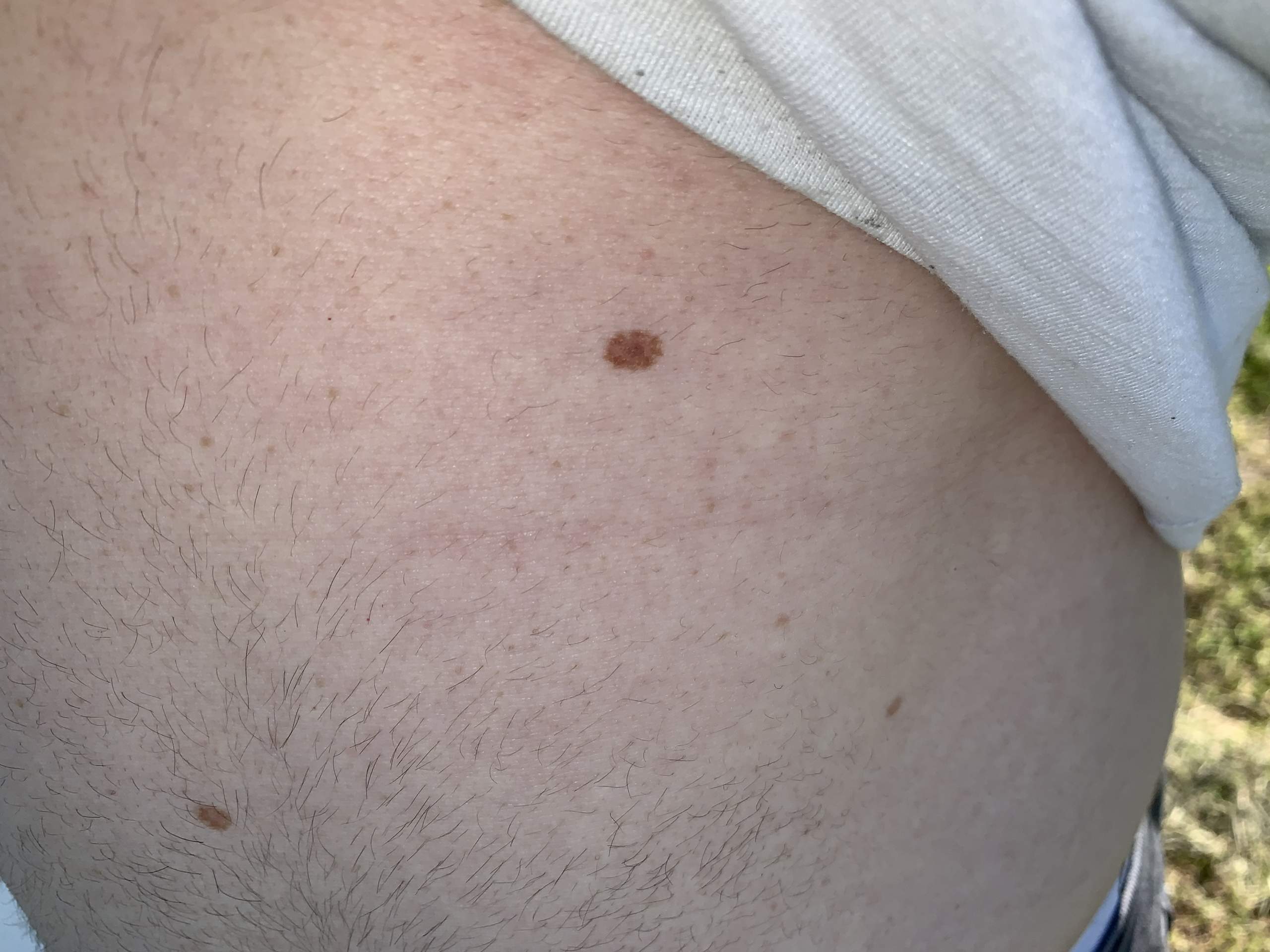 Muttermal normal oder muss man sich sorgen machen? (Gesundheit und ...