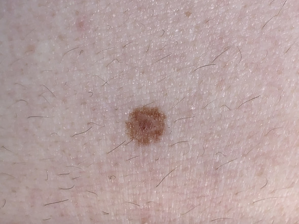 Muttermal normal oder muss man sich machen? (Gesundheit und Muttermal normal oder muss man sich machen? (Gesundheit und