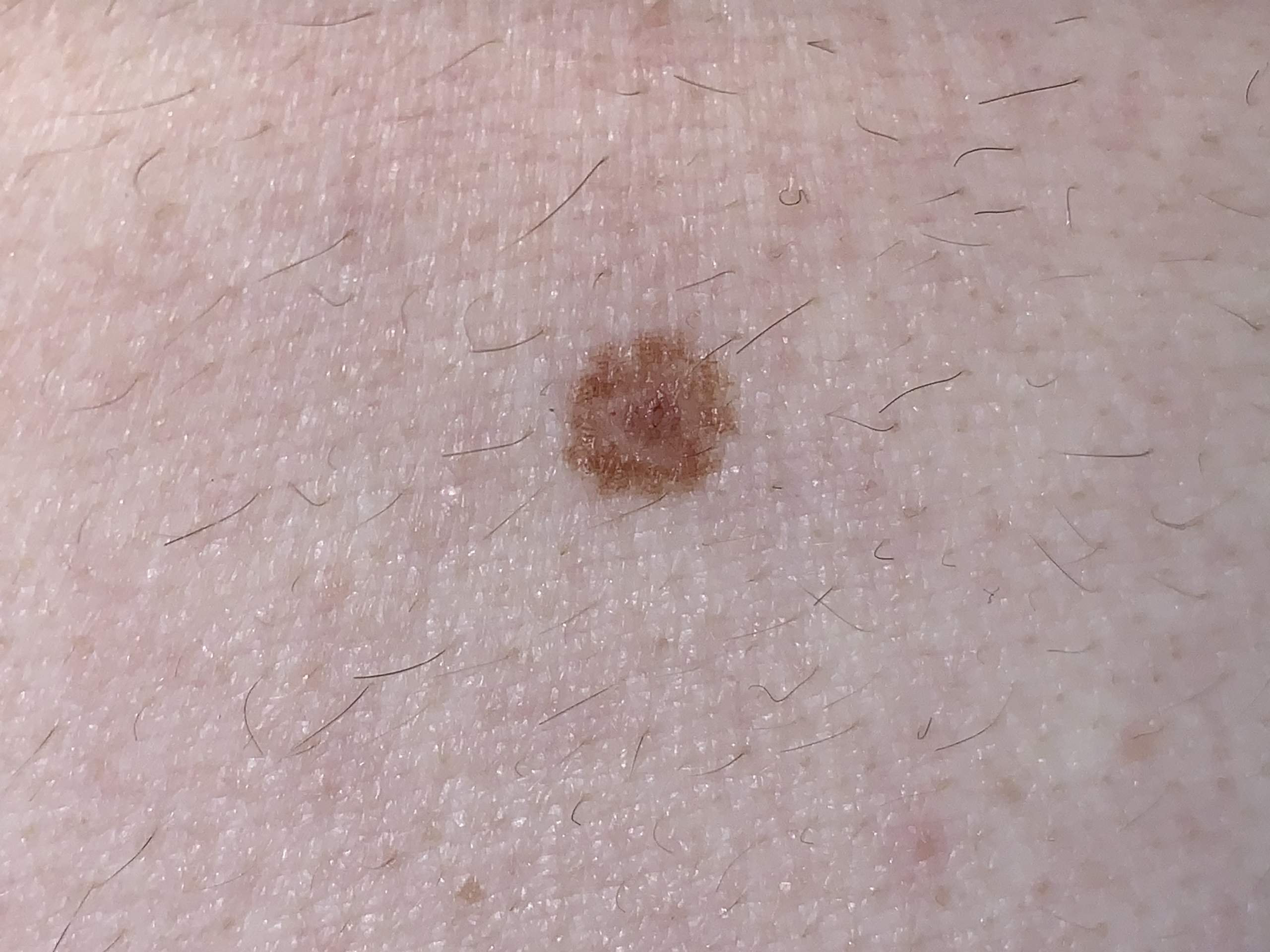 Muttermal normal oder muss man sich sorgen machen? (Gesundheit und ...