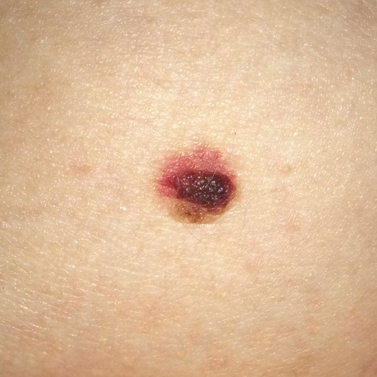 Muttermal rot gefärbt? Hautkrebs? (Mädchen, Körper, Menschen)