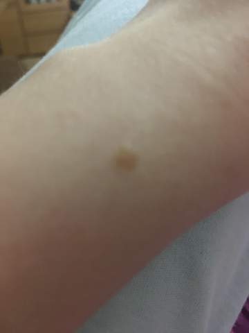 Muttermal Selber Entfernen Tipps Hautarzt Muttermalentfernung Muttermal Selber Entfernen Tipps Hautarzt Muttermalentfernung