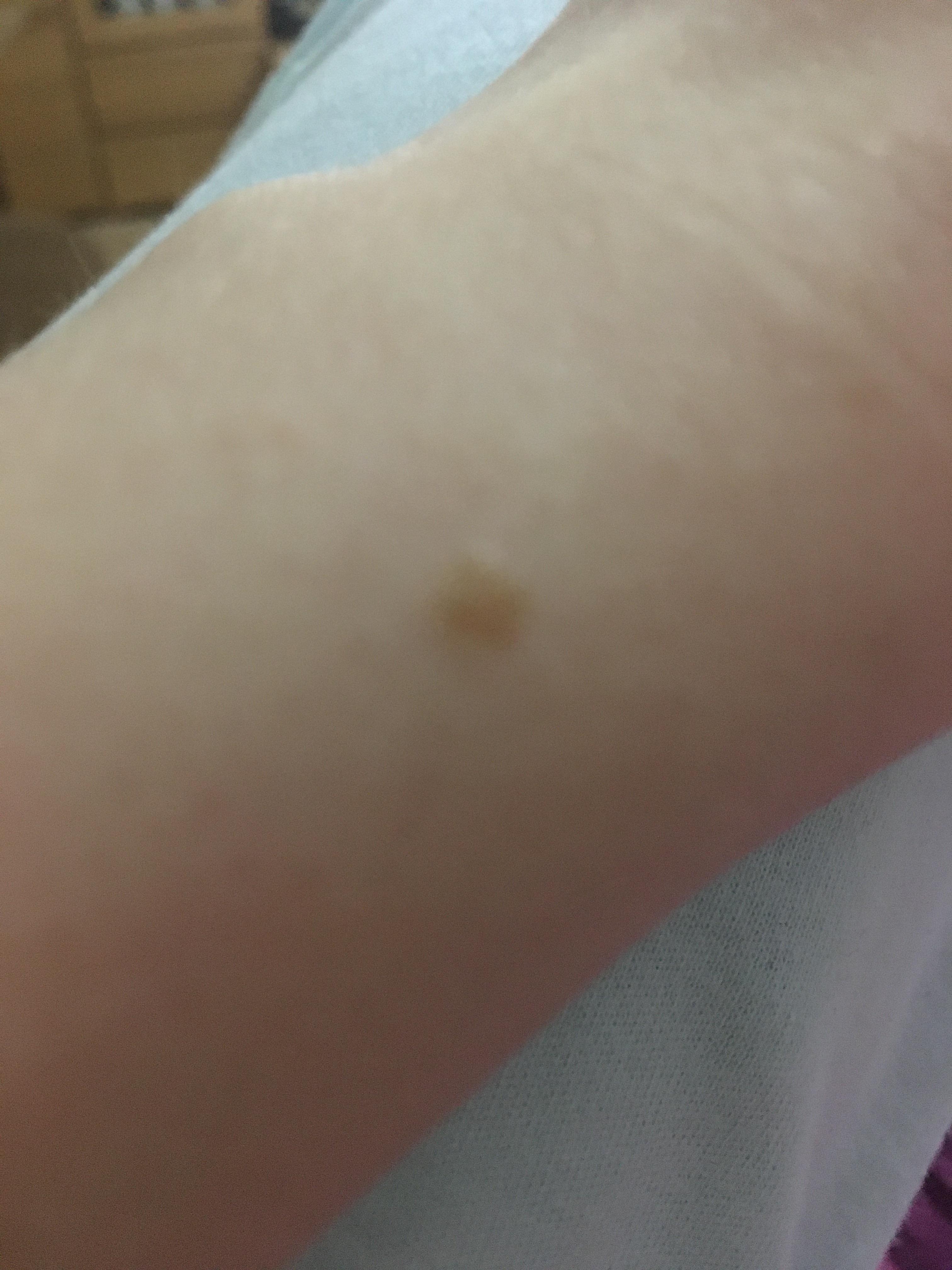 Muttermal Selber Entfernen Tipps Hautarzt Muttermalentfernung Muttermal Selber Entfernen Tipps Hautarzt Muttermalentfernung