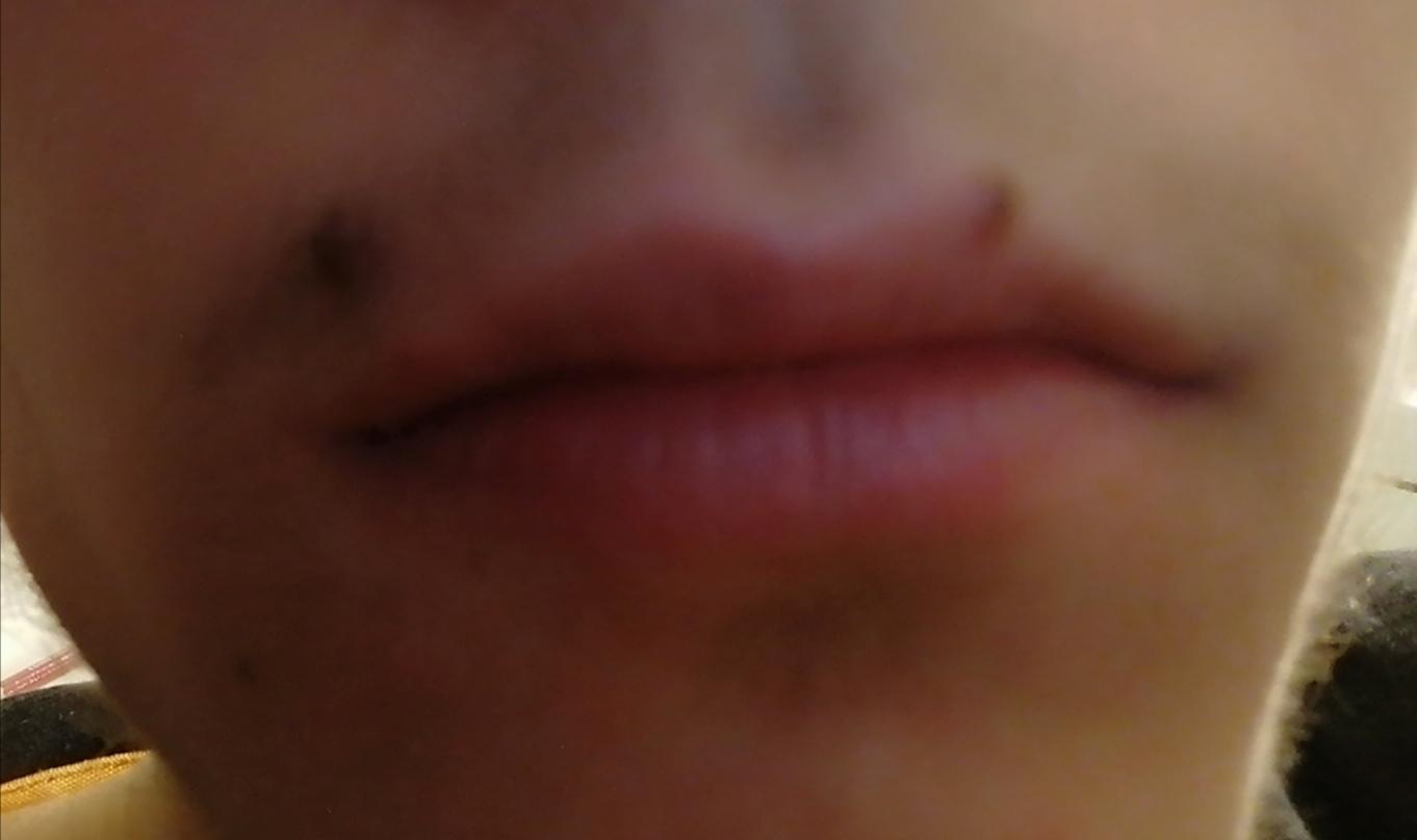 Muttermal Selbst Entfernen Gesundheit Und Medizin Gesundheit Medizin Muttermal Selbst Entfernen Gesundheit Und Medizin Gesundheit Medizin