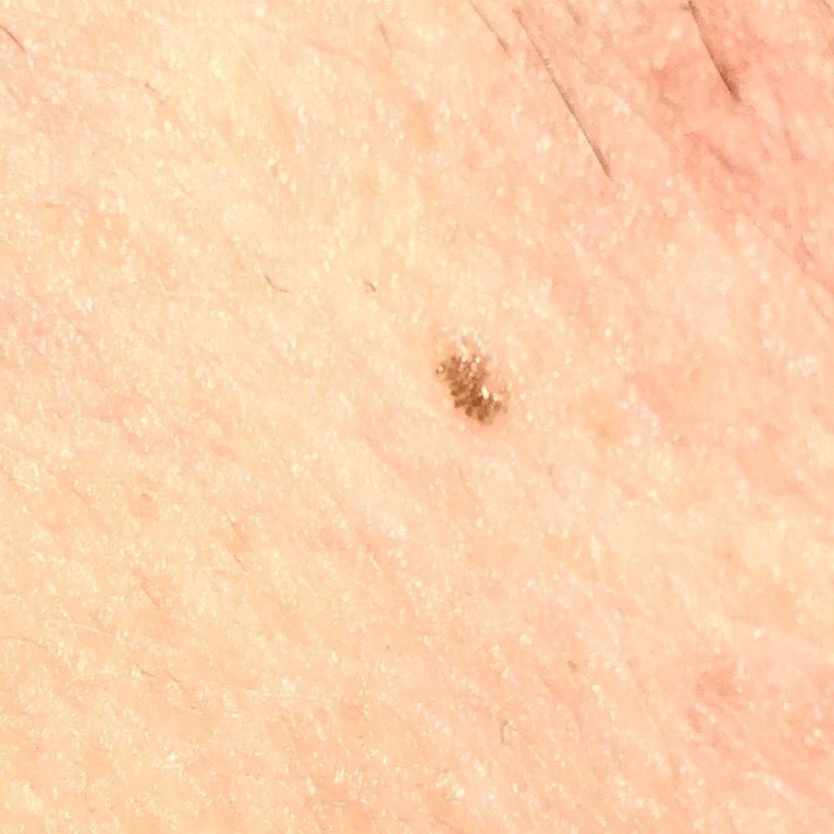 Muttermale Weg Machenn Gesundheit Haut Muttermal