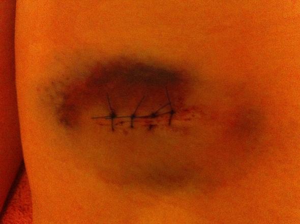 Muttermalentfernung Komplett Blau Normal Krankheit Schmerzen Haut Muttermalentfernung Komplett Blau Normal Krankheit Schmerzen Haut