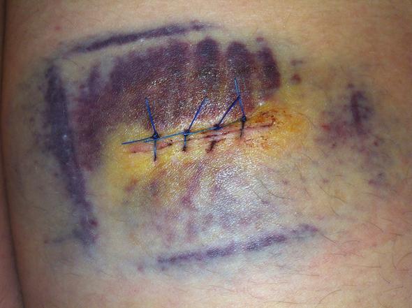 Muttermalentfernung Komplett Blau Normal Krankheit Schmerzen Haut Muttermalentfernung Komplett Blau Normal Krankheit Schmerzen Haut