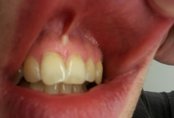 Zahnfleisch2 - (Müdigkeit, Bakterien, Herpes)