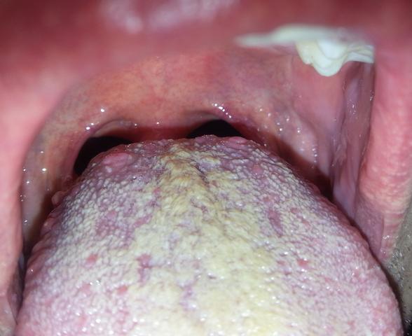 Zunge2 - (Müdigkeit, Bakterien, Herpes)