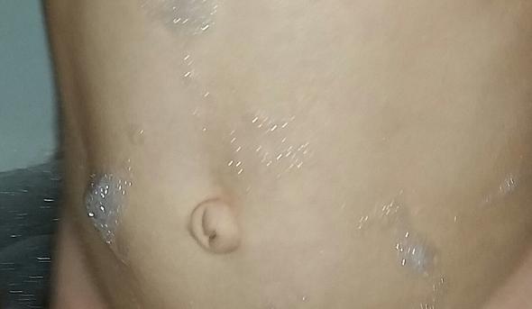 Nabelbruch Bei 2 Jahriger Op Ja Oder Nein Nabelbruch Bei 2 Jahriger Op Ja Oder Nein