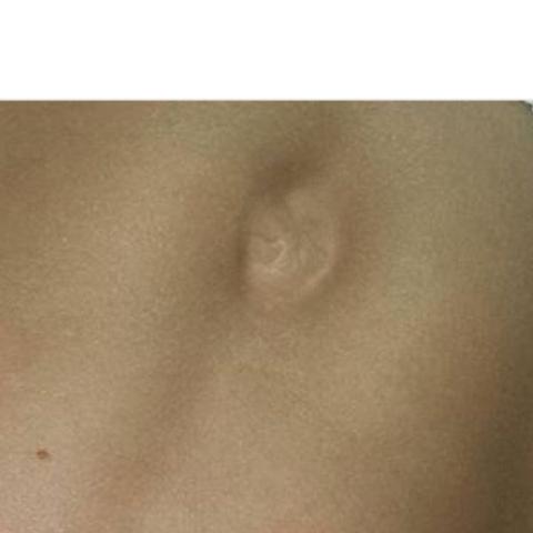 Nabelbruch Oder Nicht Bauch Nabelbruch Oder Nicht Bauch