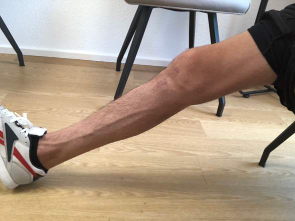 Nach 4 Monate Knie Op Vordererkreuzbandriss Schmerz Wieder Gesundheit Und Medizin Chirurgie Kreuzbandriss Nach 4 Monate Knie Op Vordererkreuzbandriss Schmerz Wieder Gesundheit Und Medizin Chirurgie Kreuzbandriss