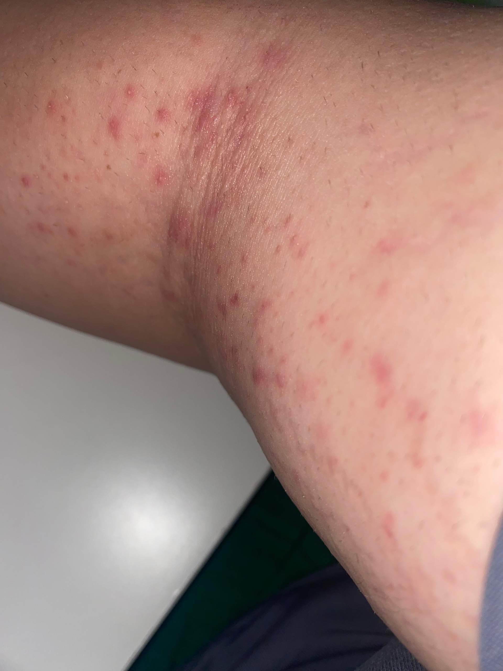 Nach arme rasieren das ist passiert? TW Bilder von Pickeln? (Pickel ...