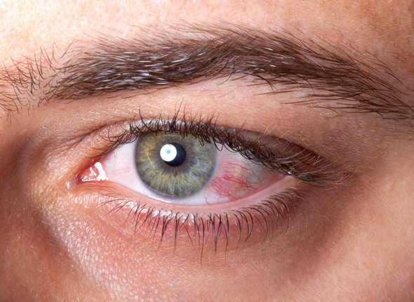 Nach Bindehautentzundung Rotung Geplatzte Ader Im Auge Gesundheit Medizin Korper Nach Bindehautentzundung Rotung Geplatzte Ader Im Auge Gesundheit Medizin Korper