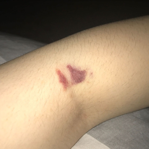 Nach Blutabnahme Immer Schlimme Blutergusse Korper Haut Blut Nach Blutabnahme Immer Schlimme Blutergusse Korper Haut Blut