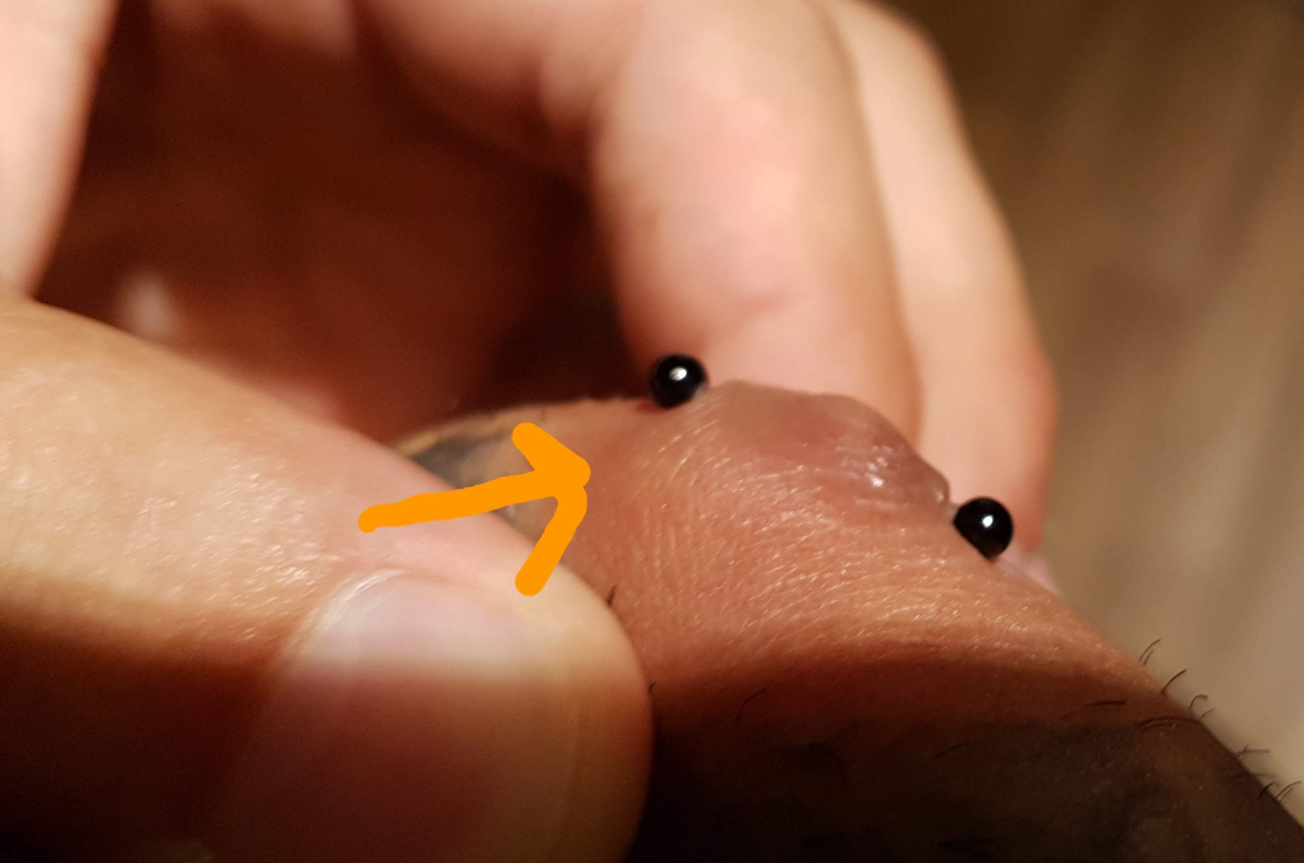 Nach Brustwarzenpiercing Einen Knoten Darunter Gefahrlich Gesundheit Und Medizin Gesundheit Piercing Nach Brustwarzenpiercing Einen Knoten Darunter Gefahrlich Gesundheit Und Medizin Gesundheit Piercing