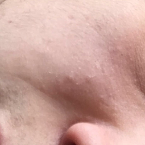 Nach Dem Abnehmen Falten Im Gesicht Uberschussige Haut Was Tun Gesundheit Medizin Schonheit