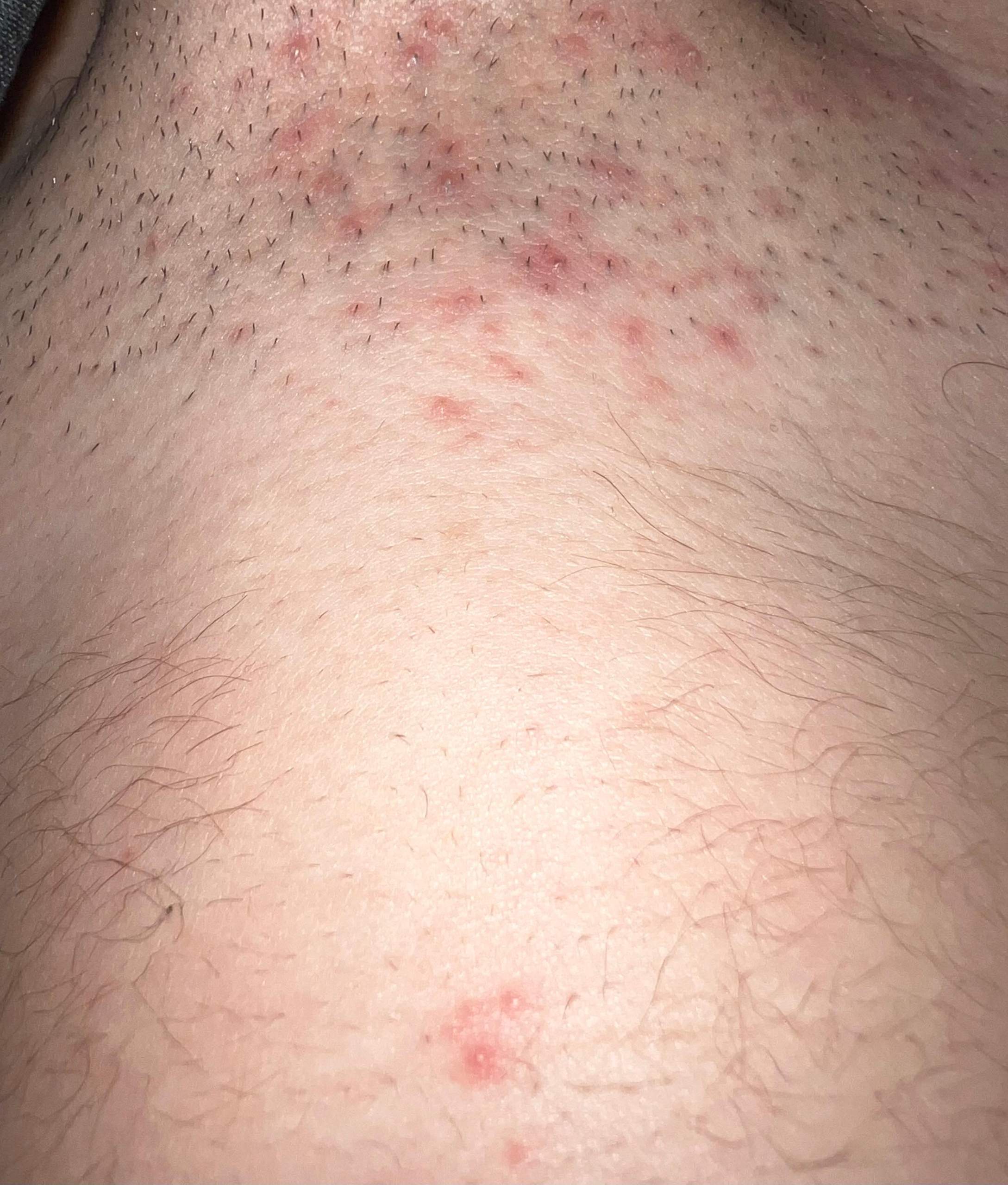 Nach dem rasieren im Intimbereich Rötungen was machen? (Pickel, Hygiene, Pickelmale)