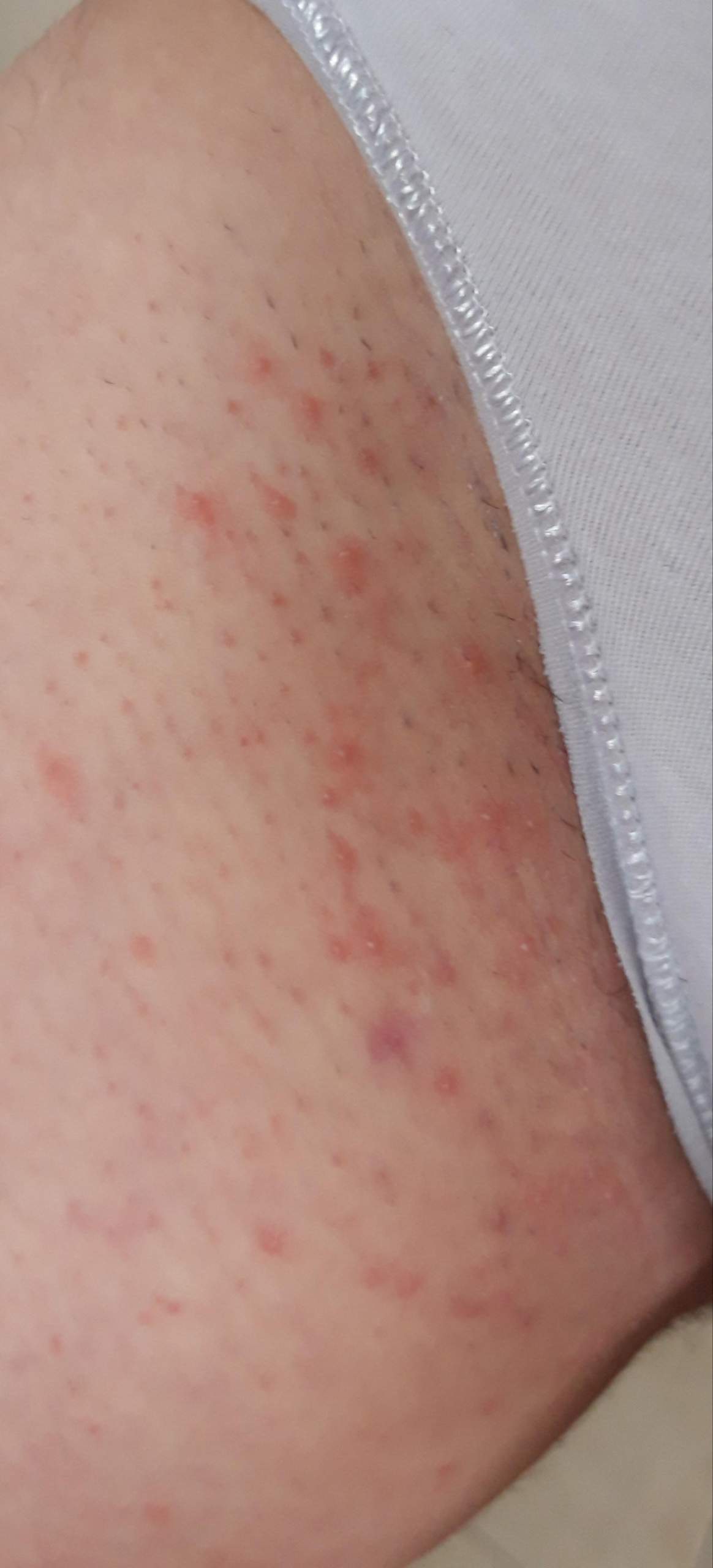 Nach Dem Rasieren Immer Pickel In Der Bikinizone Was Dagegen Tun Gesundheit Und Medizin Korperpflege Intimbereich Nach Dem Rasieren Immer Pickel In Der Bikinizone Was Dagegen Tun Gesundheit Und Medizin Korperpflege Intimbereich