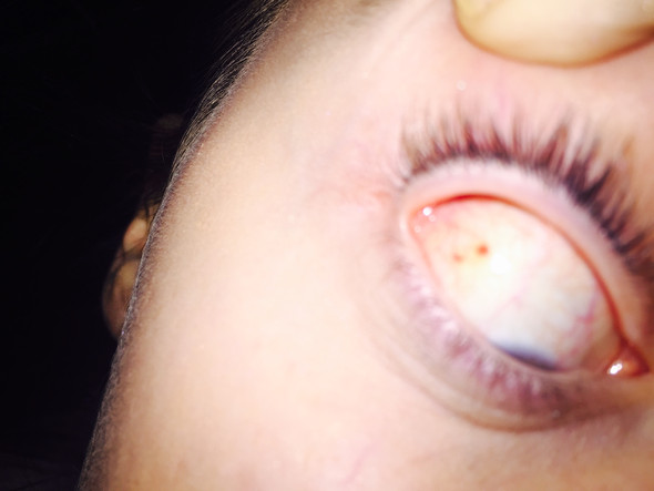 Was sind das für Punkte? Was bedeutet das? - (Gesundheit, Augen, rote punkte auge)