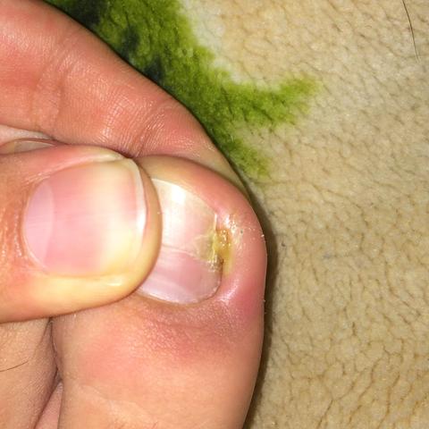 Nach Eingewachsenen Nagel Wieder Eingewachsen Und Nun Entzundet Nagel Entzundung Nach Eingewachsenen Nagel Wieder Eingewachsen Und Nun Entzundet Nagel Entzundung