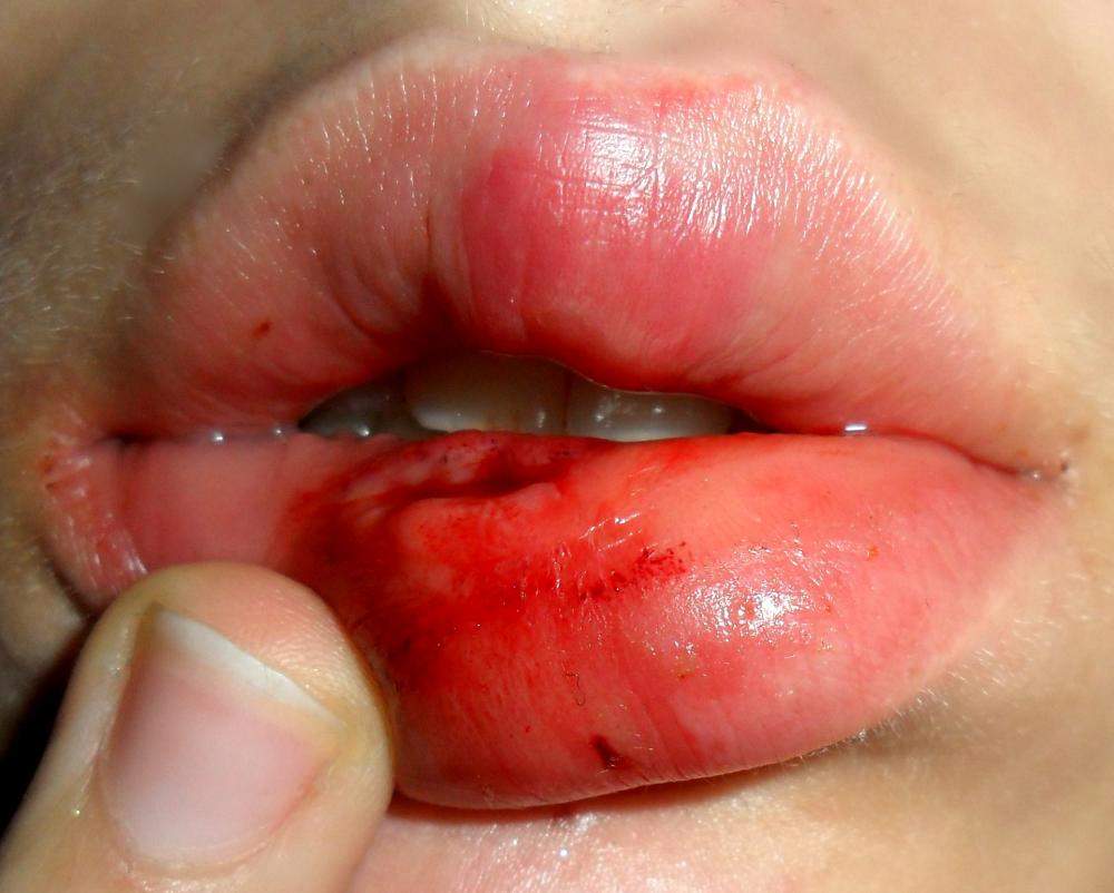 Nach Fahrradunfall Einen Knoten An Der Unterlippe Unfall Lippe Erbsen Nach Fahrradunfall Einen Knoten An Der Unterlippe Unfall Lippe Erbsen