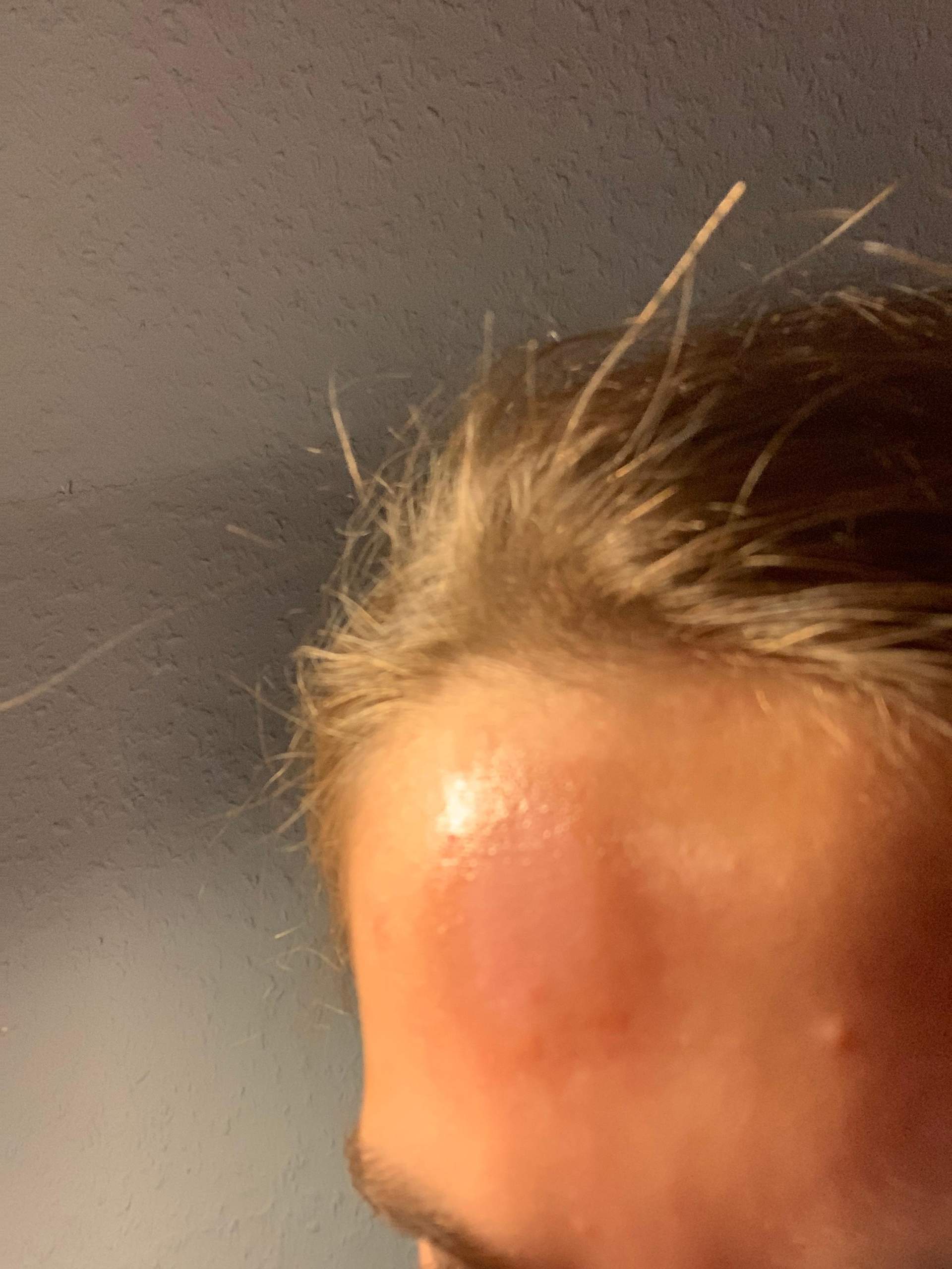 Nach Filzstift im Gesicht Ausschlag, was tuen? (Haut, Hautprobleme)