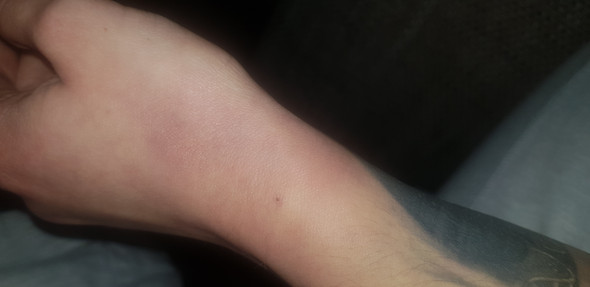 Nach Infusion Rotung Gesundheit Und Medizin Nach Infusion Rotung Gesundheit Und Medizin