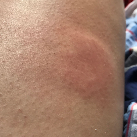 Nach Insektenstich Rote Stelle Am Bein Was Tun Schwellung Stich Muckenstiche Nach Insektenstich Rote Stelle Am Bein Was Tun Schwellung Stich Muckenstiche