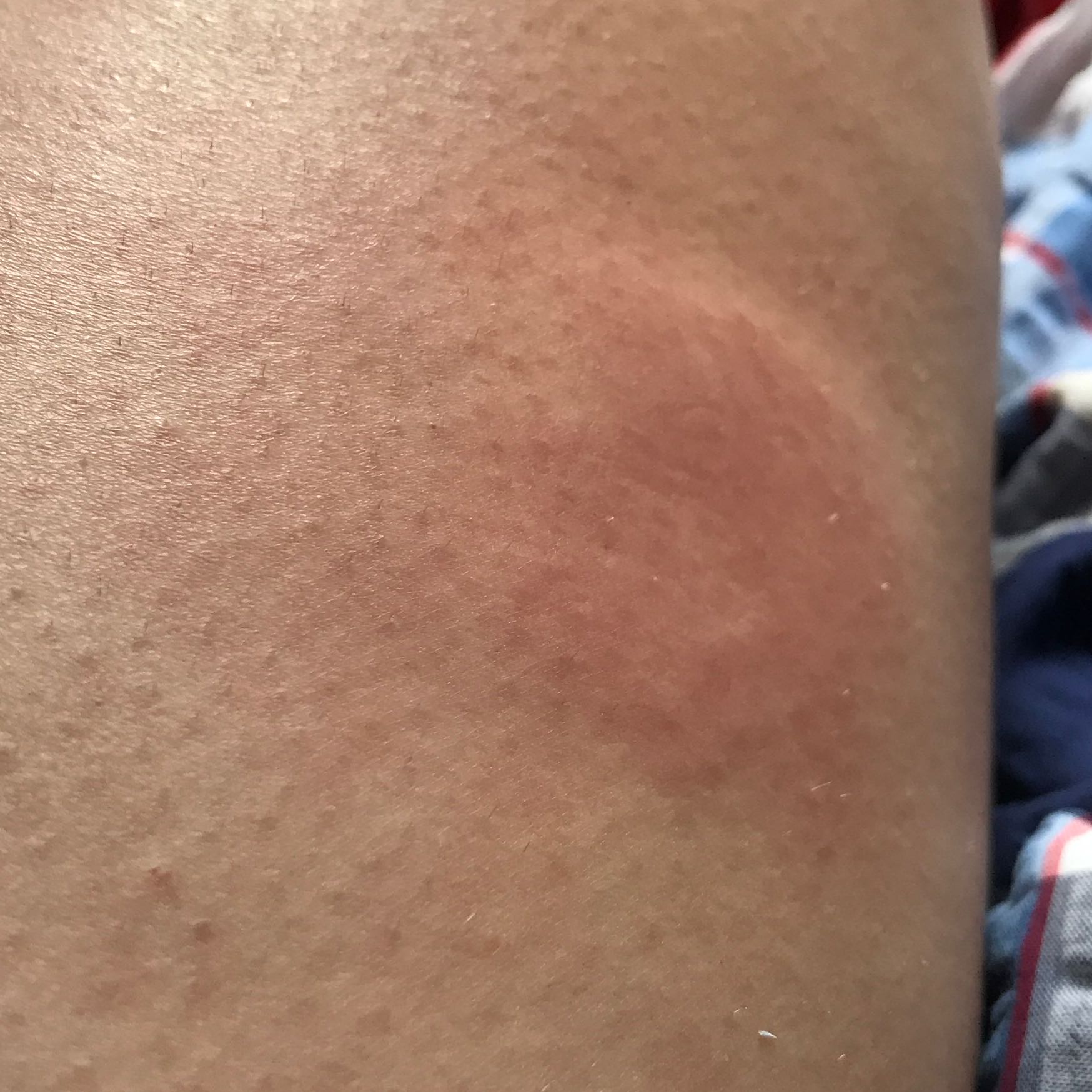 Nach Insektenstich rote Stelle am Bein - was tun? (Schwellung, Stich, Mückenstiche)