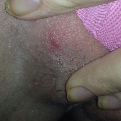 Nach Intimrasur Knubbel Schneiden Nach Intimrasur Knubbel Schneiden