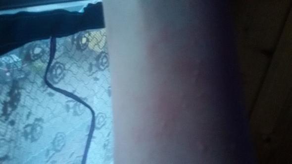 - (Gesundheit, Haut, Allergie)