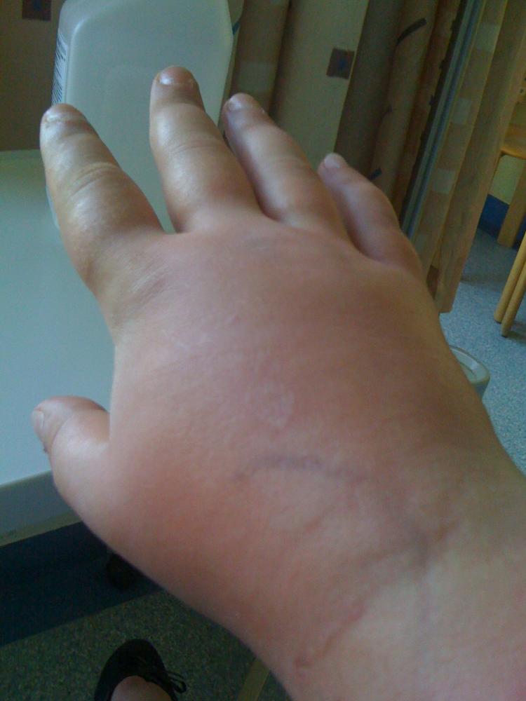 (Nach Katzenbiss & Blutvergiftung) Hand schwillt noch immer an?! (Gesundheit, Medizin, Katze)