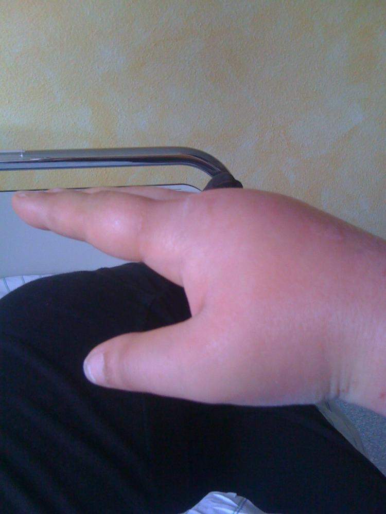 (Nach Katzenbiss & Blutvergiftung) Hand schwillt noch immer an?! (Gesundheit, Medizin, Katze)