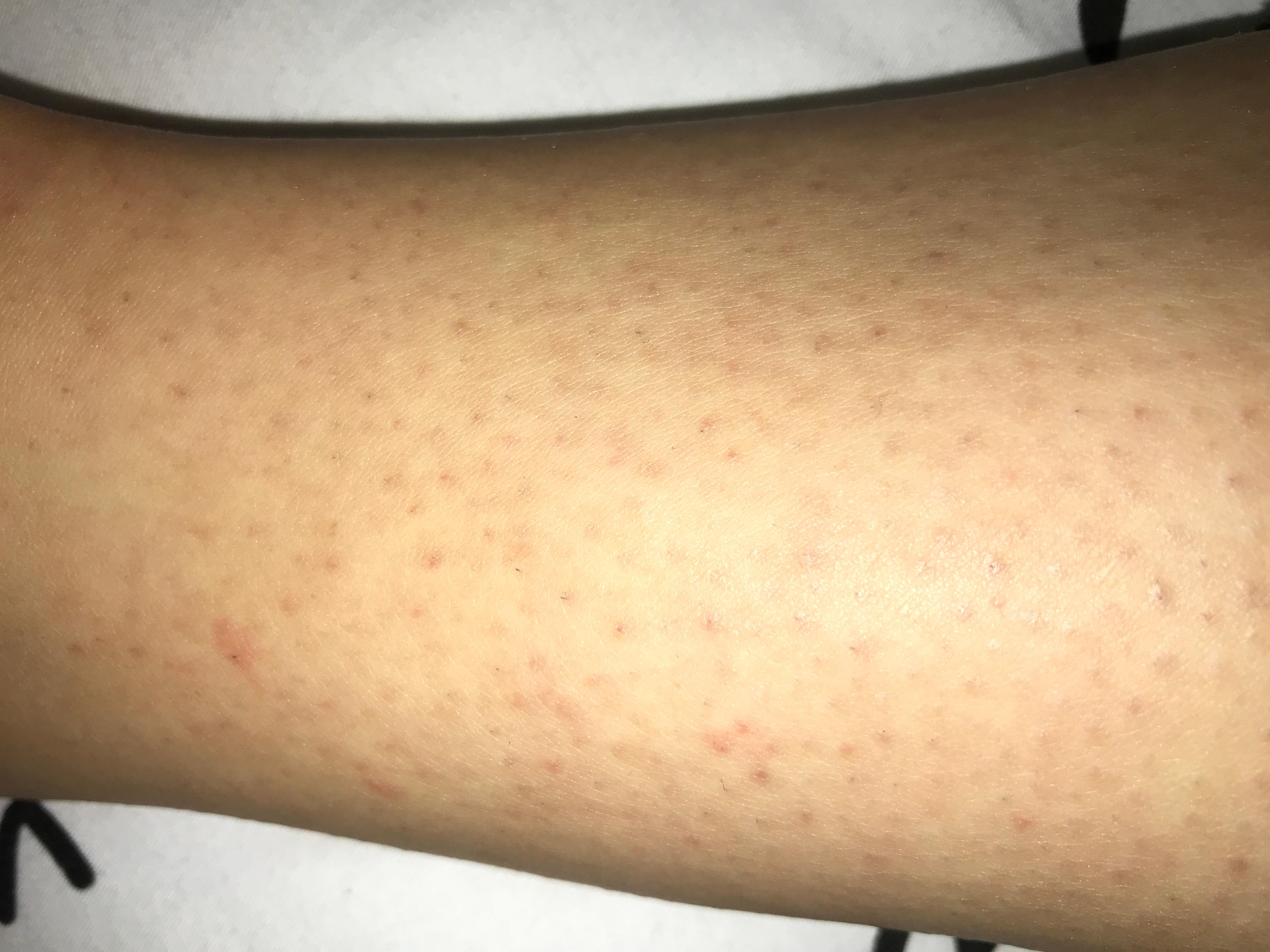 nach rasur schwarze punkte haut