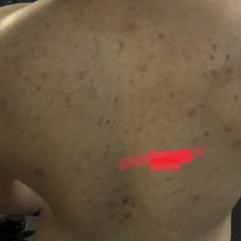 nach ruckenrasur extrem pickel