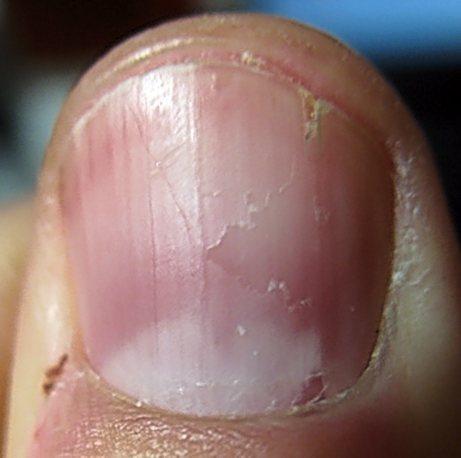 Nach Unfall Fingernagel Reisst Standig Ein Nagelbett Defekt Nagel Wachstumsstorung Beauty Haushalt Nagellack