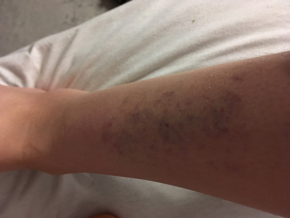 Blaue Flecke An Den Beinen Venenprobleme Und Vermehrte Blaue Flecken Blaue Flecke An Den Beinen Venenprobleme Und Vermehrte Blaue Flecken