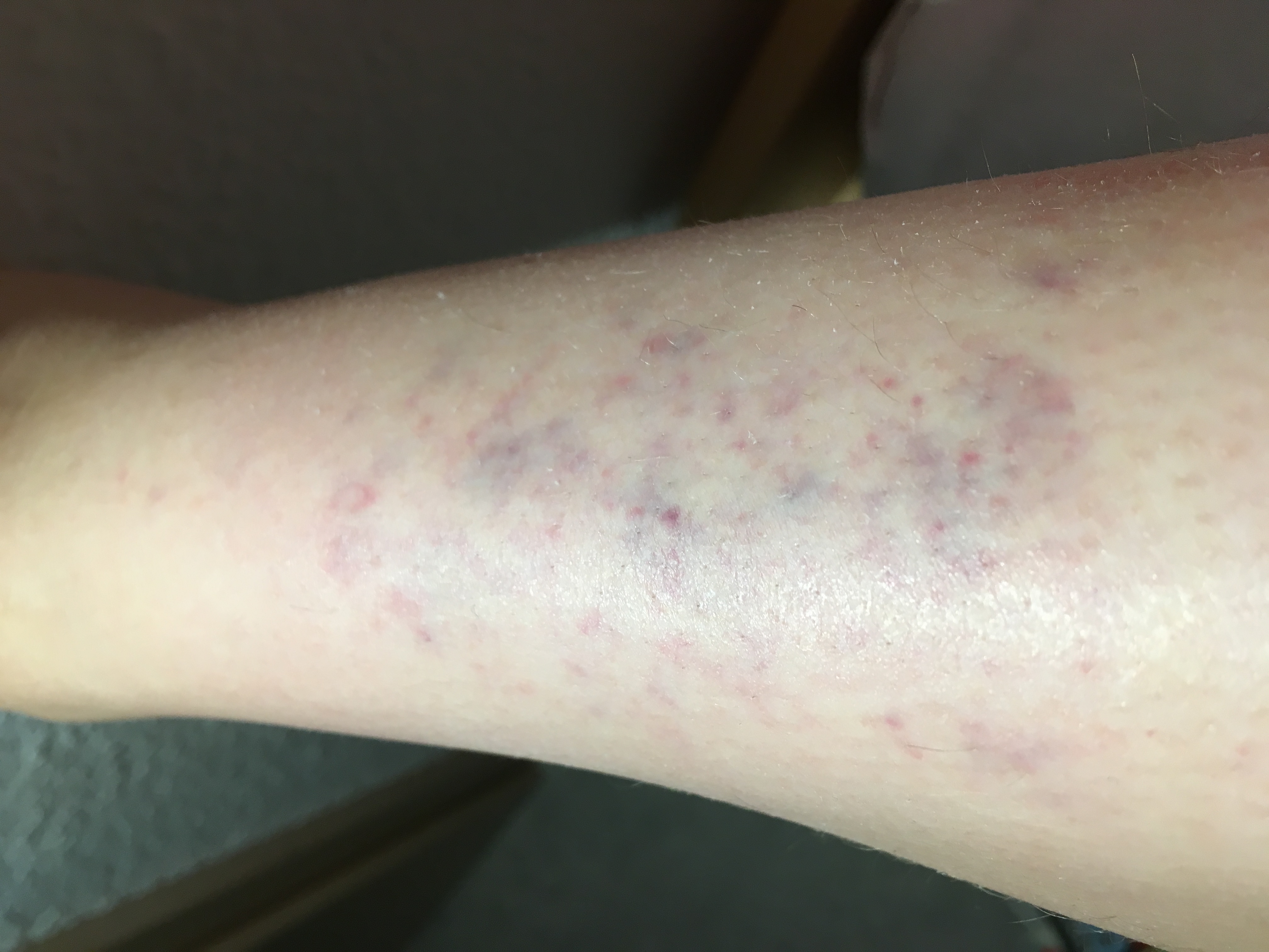 blauer fleck nach blutabnahme DrBeckmann blauer fleck nach blutabnahme DrBeckmann