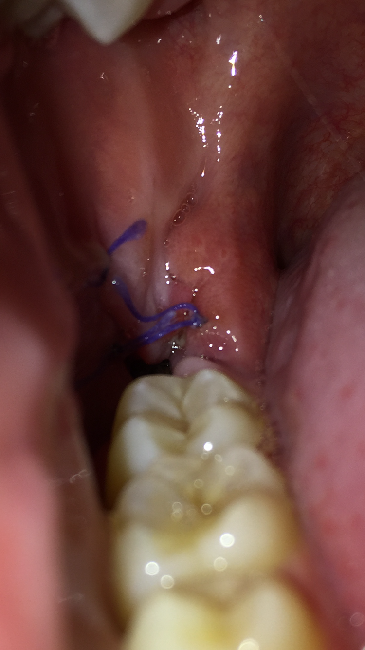 Nach Weisheitszahn OP noch Knochen/Zahn übrig? (Gesundheit und Medizin, WeisheitszahnOP)