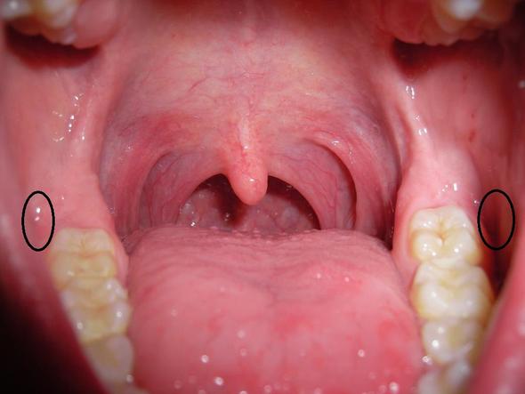 Wunde zahn in gezogen essensreste
