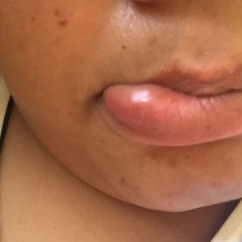 Nach Zahnarzt Besuch Und Betaubung Lippe Geschwollen Schmerzen Taub Pochen Nach Zahnarzt Besuch Und Betaubung Lippe Geschwollen Schmerzen Taub Pochen