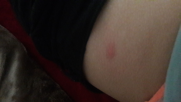 Nach Zeckenbiss So Eine Rotung Und Jucken Normal Gesundheit Und Medizin Nach Zeckenbiss So Eine Rotung Und Jucken Normal Gesundheit Und Medizin