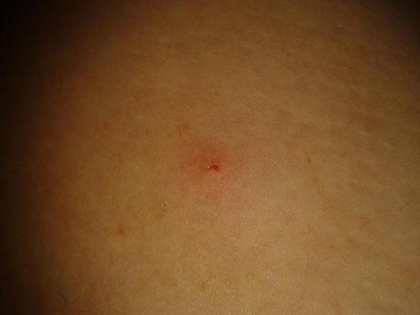 Nach Zeckenbiss Zum Arzt Zecke Nach Zeckenbiss Zum Arzt Zecke