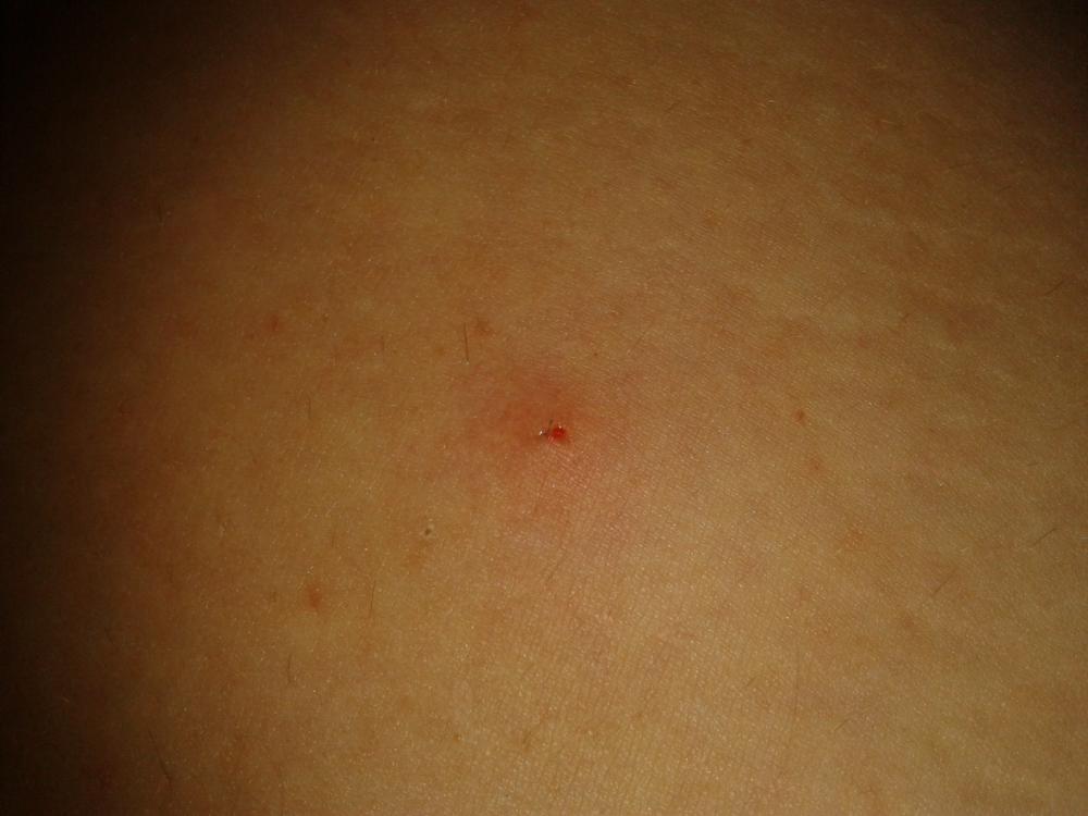 Nach Zeckenbiss zum Arzt? (Zecke)