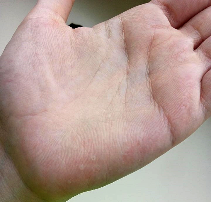 Nachtrag zur Frage bezüglich kreisrunder Bläschen an den Handinnenflächen? (blaeschen) Nachtrag zur Frage bezüglich kreisrunder Bläschen an den Handinnenflächen? (blaeschen)