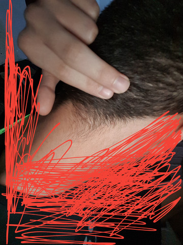 Nacken Und Hinter Kopf Schmerzen Hilfee Krebs Tumor