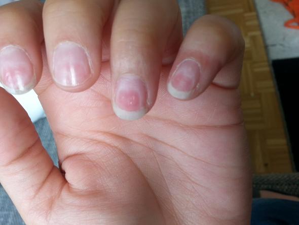 Nagel Brennen Hollisch Und Sind Gerissen Fingernagel Hauterkrankung