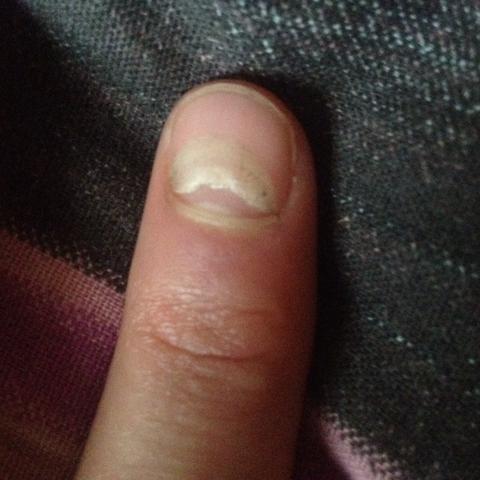 Finger Nägel - (Krankheit)